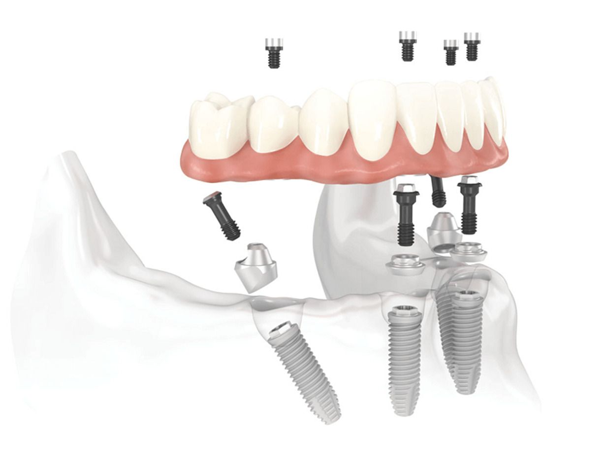 Teeth Xpress at Tri-State Center for Advanced Implants Teeth Xpress at Tri-State Center for Advanced Implants